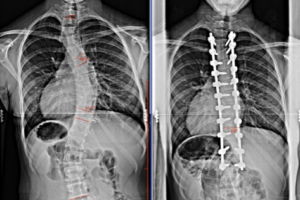 Competition After Surgery!