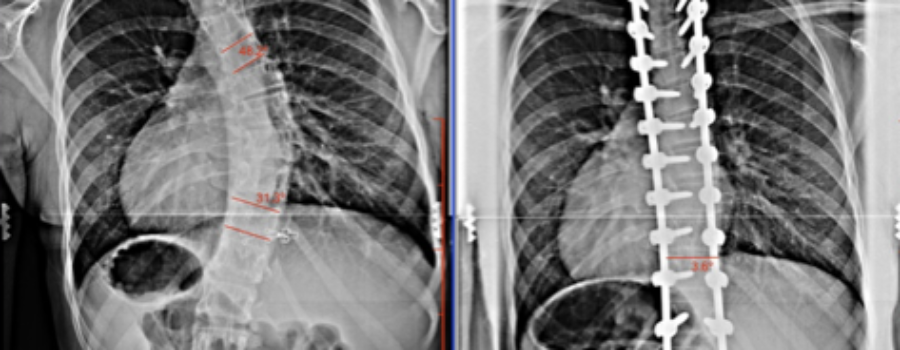 Competition After Surgery!