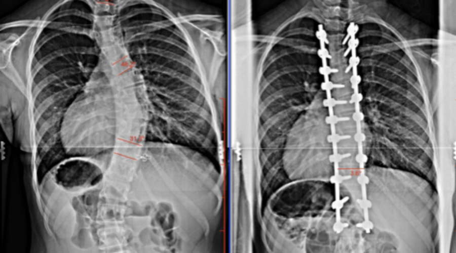 Competition After Surgery!